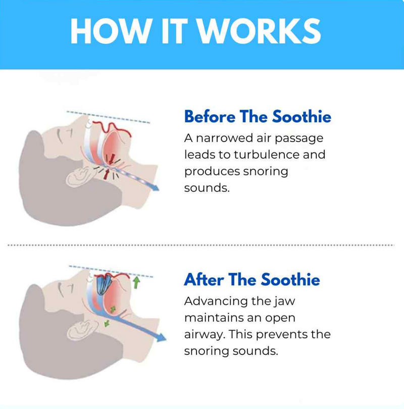 THE SOOTHIE ANTI SNORING MOUTHPIECE